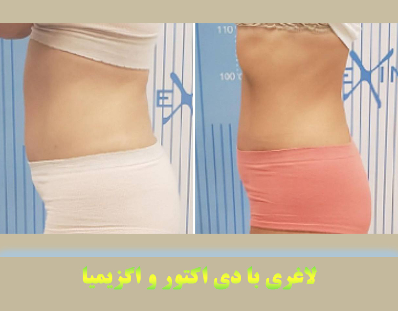 لاغری با دی اکتور و اگزیمیا