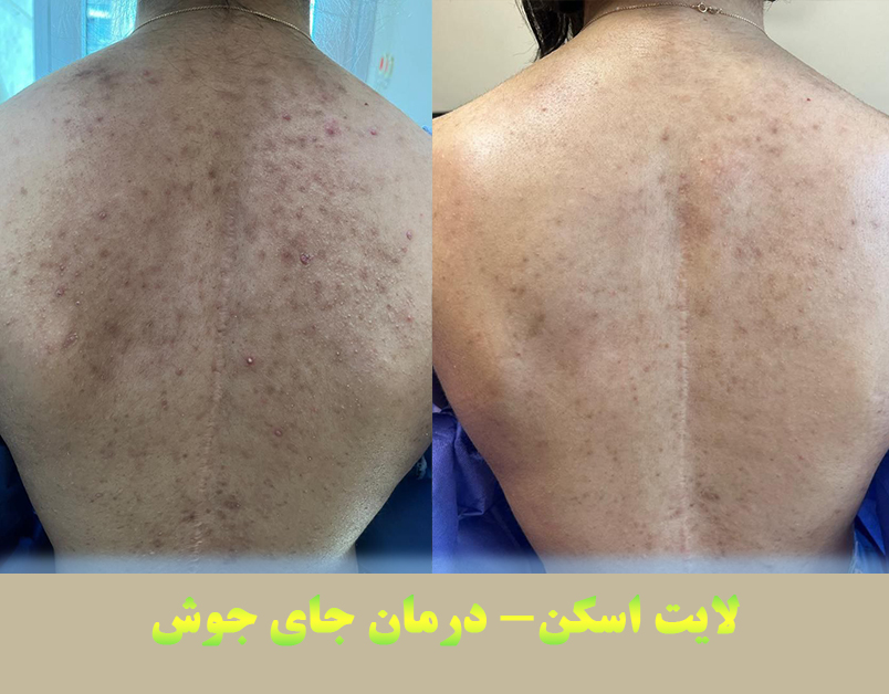 لایت اسکن برای درمان جای جوش