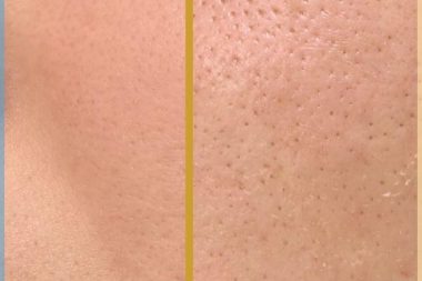 درمان منافذ باز پوستی