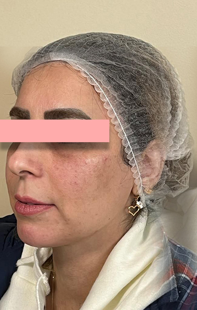 تزریق فیلر زیر چشم