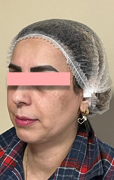 تزریق فیلر زیر چشم