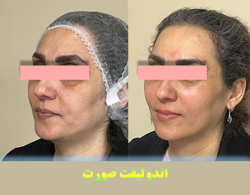 صورت قبل و بعد 2