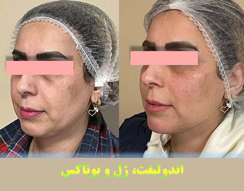 ژل زیر چشم و ژل چانه و بوتاکس