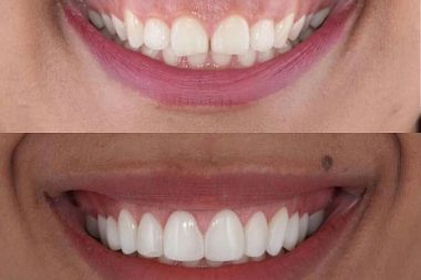 درمان لبخند لثه ای 1 درمان لبخند لثه ای