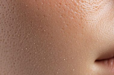 درمان منافذ باز پوست