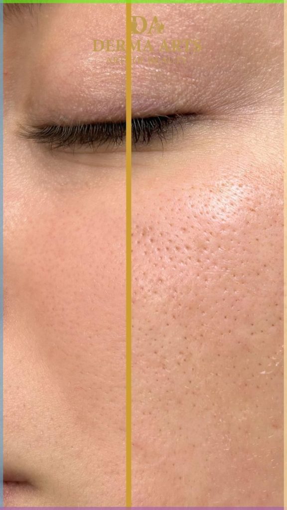 درمان منافذ باز پوستی