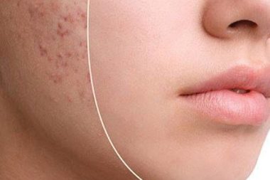 هایفوتراپی تهران