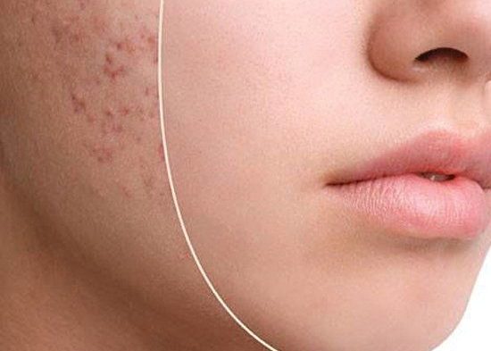 هایفوتراپی تهران