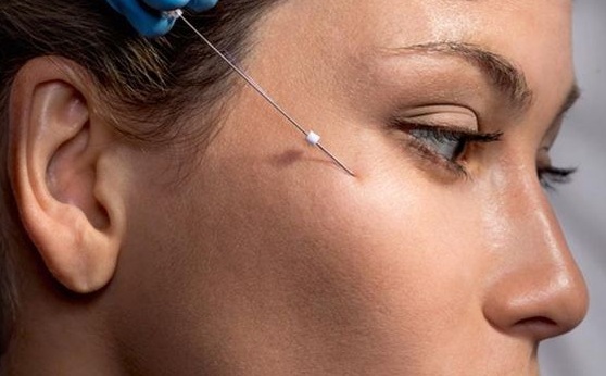 با نخ آپتوس