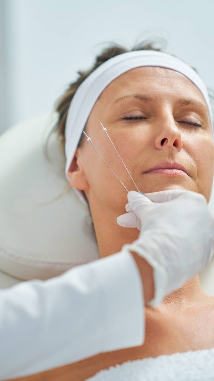 لیفت صورت با نخ آپتوس 4 نخ آپتوس تهران