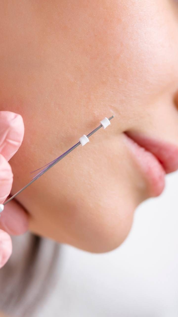 لیفت صورت با نخ آپتوس 3 نخ آپتوس